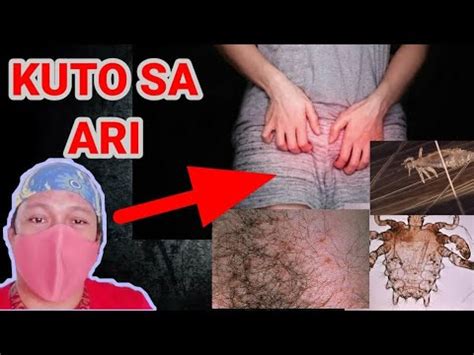 kuto sa ari|Kuto Sa Ari O Pubic Lice: Sanhi, Sintomas, at Gamot Para Dito.